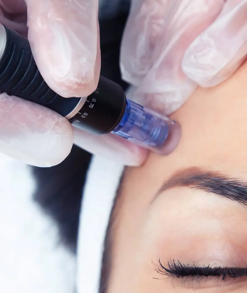 Dermapen para Cicatrices de Acné 