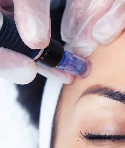 Dermapen para Cicatrices de Acné 